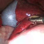 BIOPSY-FORCEPS