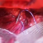 Suture-Passer-Port-Closure-device